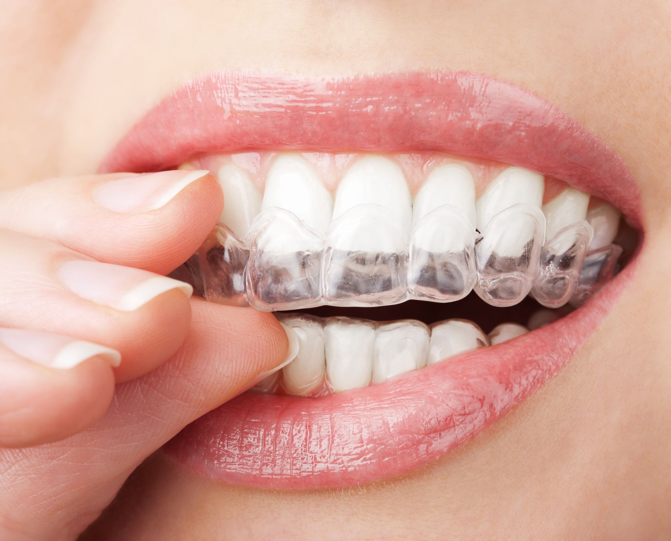 How Can Invisalign Treatments in Doral Give You Straight Teeth?